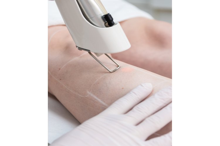 Van dagelijkse frustratie naar blijvend gemak: steeds meer Brabanders kiezen voor laserontharen