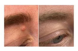 Cosmetisch storende moedervlek? Dermatologische shave-excisie nu ook mogelijk in Den Bosch