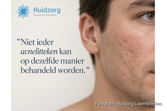Acnelittekens behandelen: waarom het soort litteken bepaalt wat werkt?