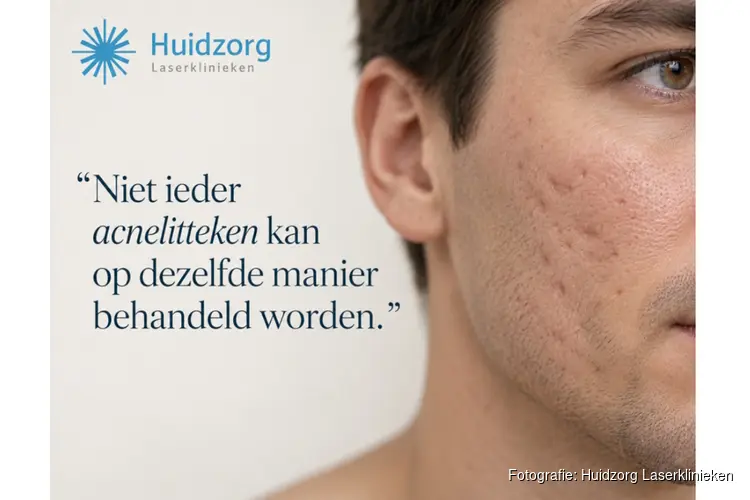 Acnelittekens behandelen: waarom het soort litteken bepaalt wat werkt?